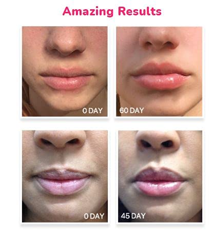 LifeCell Lip Plumping Treatment