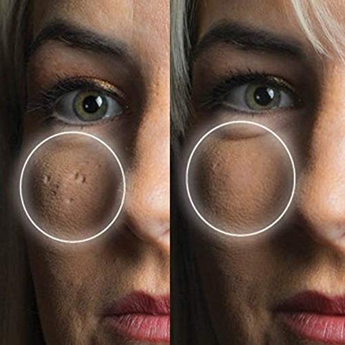 Dermaflage Scar Filler Kit - Medium - Deep Scar Cover and Waterproof Concealer for Acne Scars Wrinkles, and Ice Pick Scars Makeup, 1 mo supply