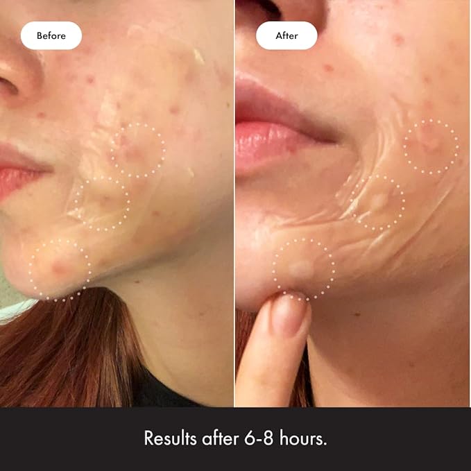 Mighty Patch Surface Large Pimple Patches for Face from Hero Cosmetics, Acne Spot for Body, Cheek, Forehead, and Chin, Pimple Stickers, Hydrocolloid Covers, Vegan-friendly, 10 Count