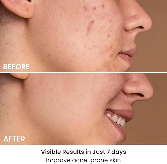 AMIRO Spectra 5-in-1 Light Therapy Face Mask, Contour With Blue, Red, Green, Yellow, and Infrared Light, 3 Modes for Oily, Acne-Prone, and Sagging Skin, Skincare for Face, Silver