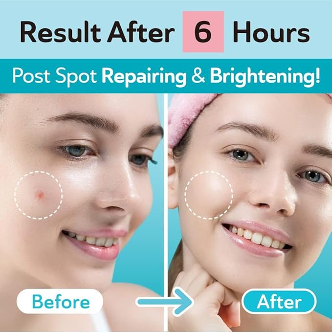 Invisible Pimple Patches for Cystic Acne - Ultra Thin Hydrocolloid Acne Patches & Zit Stickers, Cystic Acne Patch for Surface Blemishes - 48 Count - 2 Sizes Invisible Plus (Clear Patch)