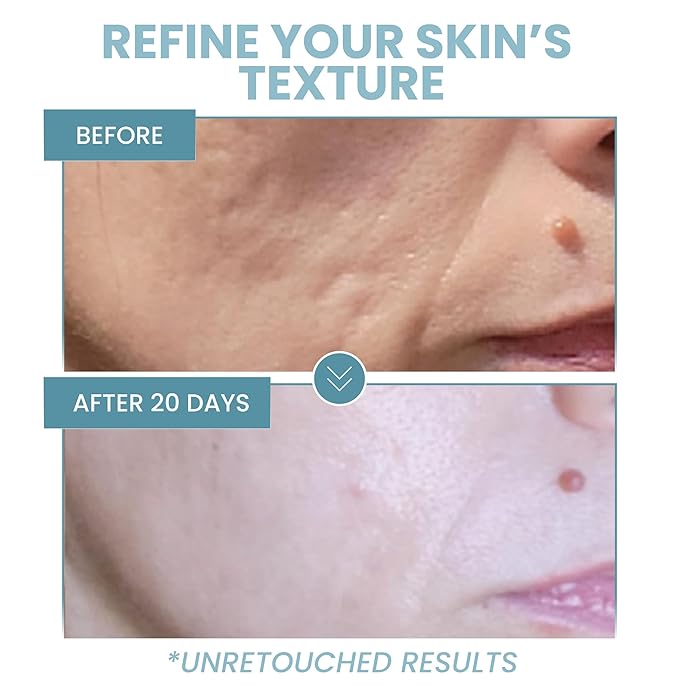 Eva Naturals Niacinamide 5% Serum for Face – B3 Pore Minimizer, Acne Treatment & Dark Spot Corrector with Hyaluronic Acid, Vitamin E, Aloe & Neem – Anti-Aging, Non-Greasy, Hydrating, 2oz