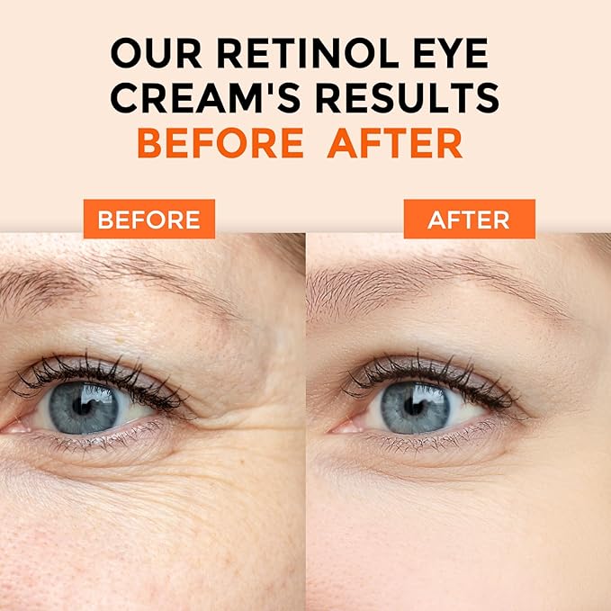Retinol Eye Cream for Dark Circles and Puffiness, Anti Aging Under Eye Cream with Hyaluronic Acid, Retinol & Collagen to Fight Fine Lines, Wrinkles & Dark Spots