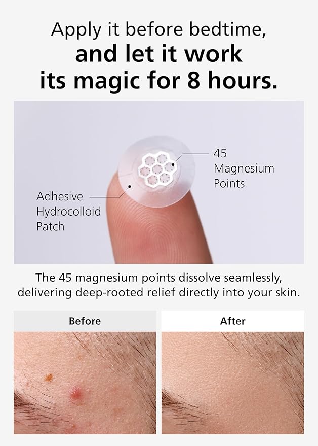 EasyDerm Quick Calming Magnesium Patches – Hydrocolloid Acne Spot Treatment Includes Tweezers & Ampoule, 10 Patches, Zit Sticker, Back to School MUST HAVE, Made by Daewoong Pharmaceutical