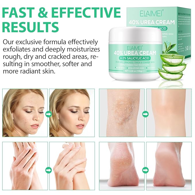 J&H Jasmine&Hyacinth 40% Urea Cream with 2% Salicylic Acid, Aloe, Feet/Heel Cream Moisturizer for Dry Cracked Heel, Knees, Elbows, Hands, Callus Remover, Intensive Hydrating Treatment-5.3 OZ/150 G