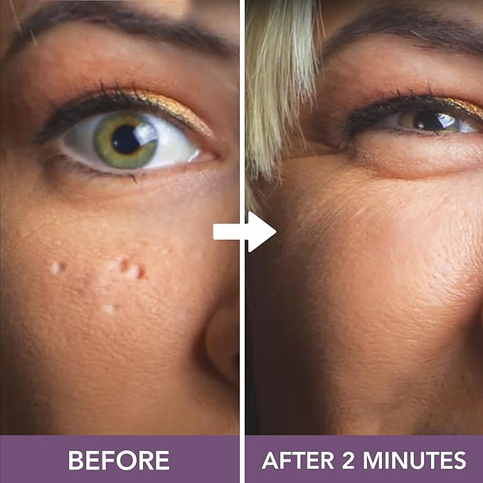 Dermaflage Scar Filler Kit - Medium - Deep Scar Cover and Waterproof Concealer for Acne Scars Wrinkles, and Ice Pick Scars Makeup, 1 mo supply