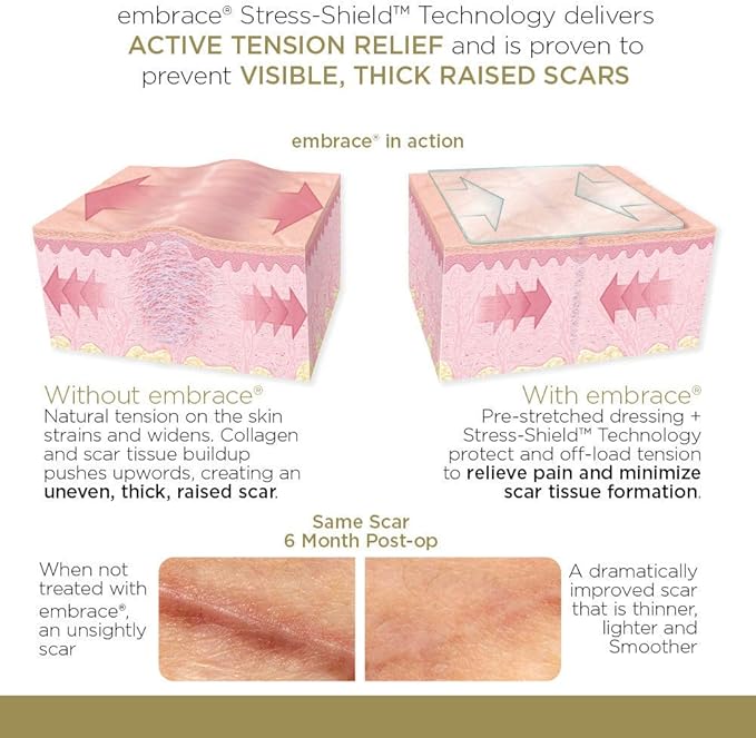 Embrace Active Scar Defense for New Scars, FDA-Cleared Medical-Grade Silicone Scar Sheets for Hypertrophic & Keloid Scar Treatment, 6.3 Inch, Extra-Large, 30-Day Supply