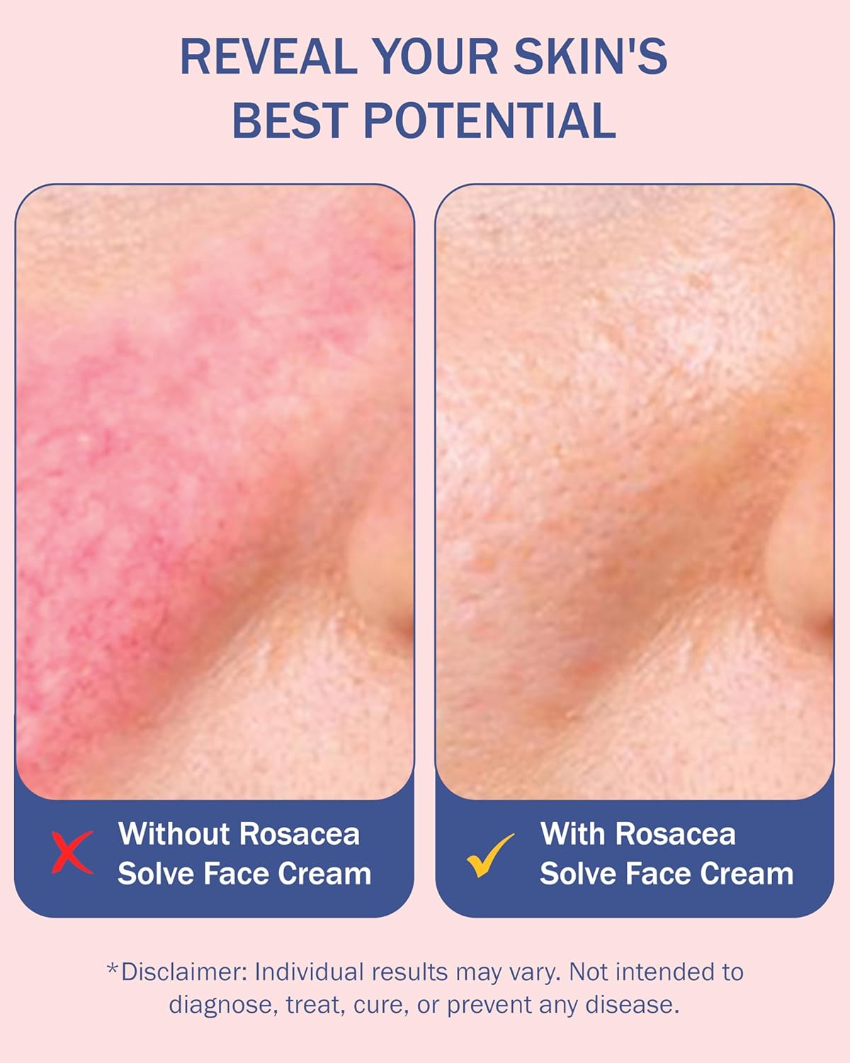 Rosacea Treatment Skincare Face Serum for Women & Men - Gentle Face Serum Moisturizer Redness Reducing Skin Care with 10% Azelaic Acid, Made in USA by e70 (2 fl. oz)