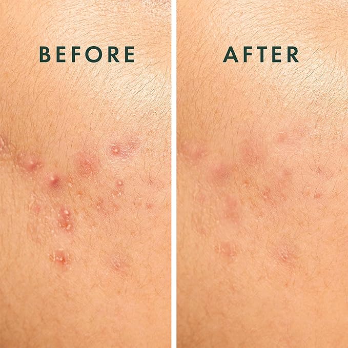 Rael Pimple Patches, Miracle Spot Control Cover - Hydrocolloid Acne Patch, Strips for Zits and Blemish, Korean Skin Care, Vegan, Cruelty Free (10 Count)