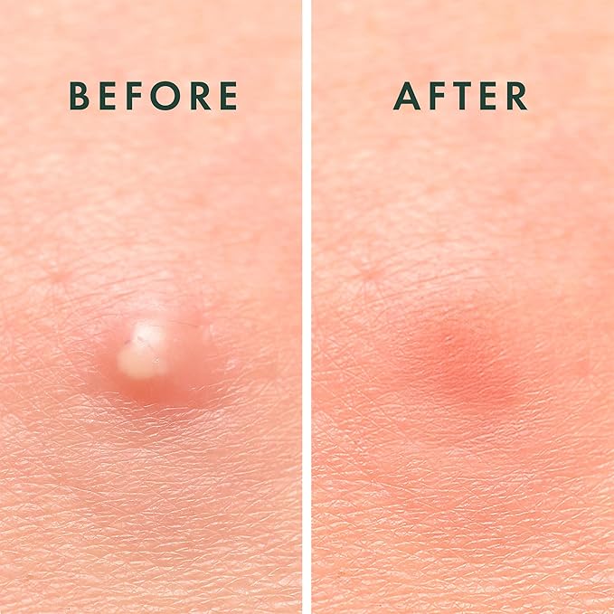 Rael Pimple Patches, Miracle Invisible Spot Cover - Hydrocolloid Acne Patch, Treatment for Breakouts, Absorbs Zits & Blemish, Korean Skin Care, 2 Sizes (72 Count)