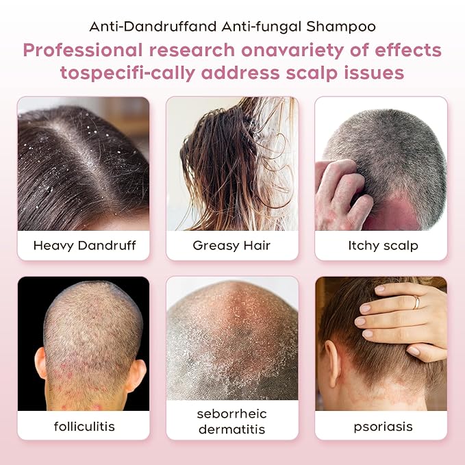 24HR Fast Itch Relief Anti-Fungal Shampoo for Psoriasis, Seborrheic Dermatitis & Folliculitis, Relieves Itchy, Dry Scalp, Sulfate & Paraben Free Anti-Dandruff Shampoo for Men and Women, 8.4 fl oz