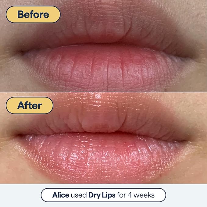 Remedy for Dry Lips - Hydrating and Healing Lip Balm Ointment with Ceramides, Peptides, and Dimethicone - Repairs Dry, Cracked Lips - By Dermatologist Dr. Shah