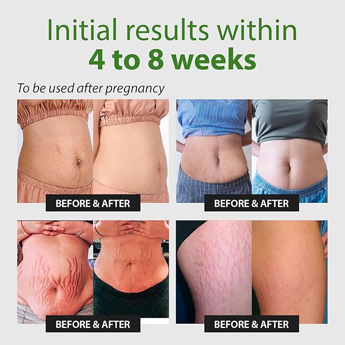 Abera Ovela Maternity Stretch Mark Cream for Pregnancy and Weight Fluctuations, Stretch Mark Treatment Pregnancy Must Haves, Deep Stretch Mark Removal, All Skin Types, 1.69 fl oz, Set of 2