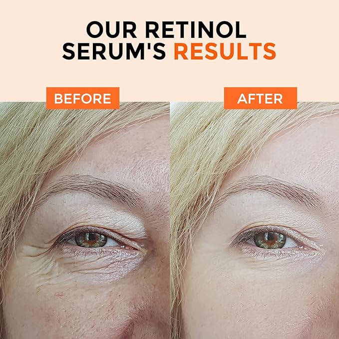 Retinol Serum for Face 2.5%, B5 Resurfacing Retinol Serum with Vitamin C, Vitamin E, Hyaluronic Acid, Niacinamide, Peptide for Anti-Aging, Wrinkle Smoothing, Dark Spot Corrector, Brighten Dullness