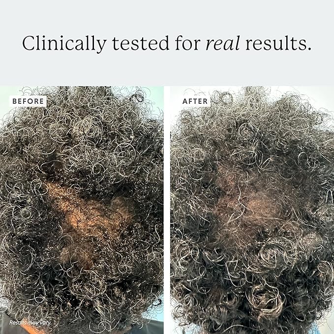 Densifying Scalp Serum, 1 fl oz, with Procapil and Redensyl, 58% Hair Loss Reduction